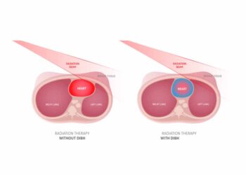 Deep Inspiratory Breath Hold (DIBH) is a game changing modern technique in Breast Cancer Radiotherapy